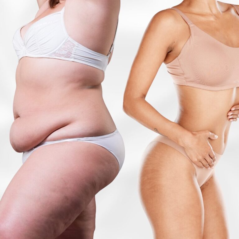 tummy tuck