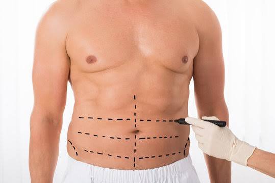 man procedure Liposuction Orlando