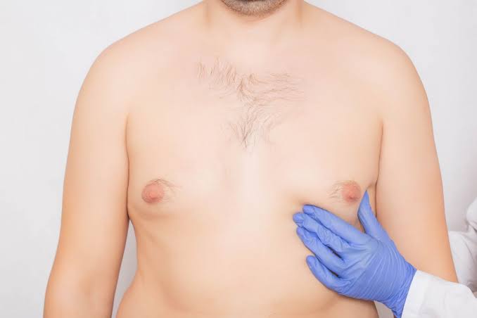 men gynecomastia orlando florida
